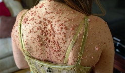 Hình ảnh về người phụ nữ với hàng nghìn khối u trên cơ thể