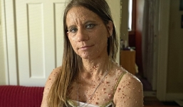 Người phụ nữ có gần 6.000 u bướu trên cơ thể