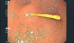 Suýt thủng dạ dày vì vừa ngậm tăm vừa uống nước