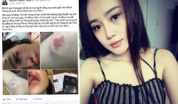 Lời kể của thiếu nữ xinh đẹp bị giật túi và ngã đến biến dạng mặt