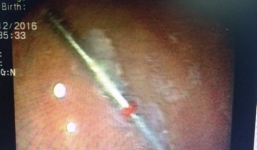 Người phụ nữ đi cấp cứu vì nuốt phải...mũi khoan nha sĩ