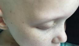 Bức ảnh sợi lông mi cuối cùng và phép màu đến với bé gái ung thư