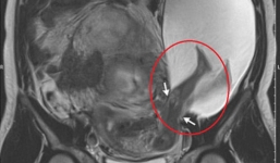 Thai nhi 22 tuần tuổi đạp rách tử cung mẹ