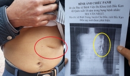 Phát hiện chiếc kéo bác sĩ để quên trong bụng bệnh nhân sau 18 năm