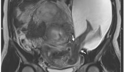 Hy hữu thai nhi 'nghịch ngợm' đạp thủng tử cung mẹ 