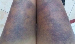 Hà Nội: Cô gái 'tố' người yêu đánh dã man