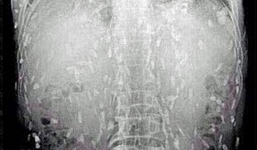 Người đàn ông phát hiện cơ thể chứa đầy sán dây vì nghiện ăn cá sống