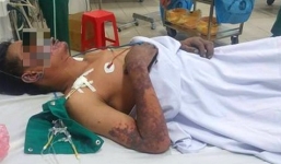  Bị ban hoại tử toàn thân sau khi ăn tiết canh 'lợn cắp nách'