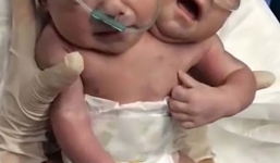 Em bé sinh ra đã có hai đầu khiến dân mạng xót xa