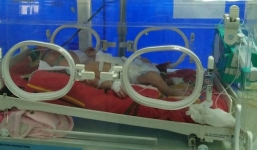 Hy hữu cứu sống bé sơ sinh bị thủng ruột từ trong bụng mẹ