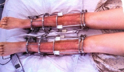 Cận cảnh quy trình phẫu thuật kéo dài chân đầy đau đớn