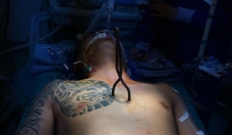 Hi hữu: Cứu sống bệnh nhân bị 6 vết thương thủng tim