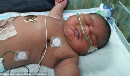 Bé sơ sinh có cân nặng 6,3kg 