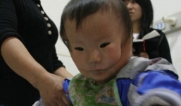 Xót xa em bé mang hai khuôn mặt vì mắc dị tật cực hiếm