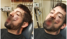 Thuốc lá điện tử phát nổ, thanh niên mất 7 chiếc răng