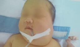 Cắt bỏ khối bướu vùng cổ lan lên não ở bé gái 20 ngày tuổi