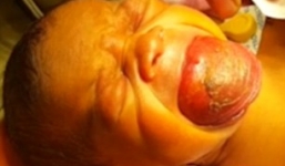 Video: Bé sơ sinh có lưỡi to như quả mận