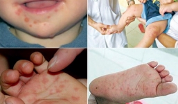 Bé 19 tháng tuổi tử vong do bệnh tay chân miệng vào mùng 1 Tết