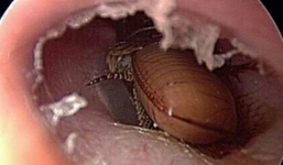 Gián bò vào tai, người đàn ông tự xịt thuốc trừ sâu 