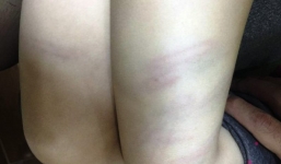 Bé gái 3 tuổi bị cô giáo mầm non đánh thâm tím 2 đùi