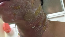 Can ngăn ẩu đả, một thai phụ bị tạt nước sôi vào người