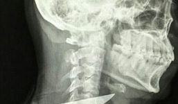 Bị dao đâm xuyên cổ, nam tài xế thoát chết thần kỳ