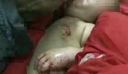 Trung Quốc: Bé trai 4 tháng tuổi bị chó cắn mất ngón tay