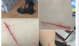 Thêm 1 cô gái 'tố' bị nhóm biến thái rạch đùi trong đêm ở Sài Gòn