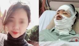 Cô gái bị bỏng toàn bộ mặt vì bóng bay phát nổ