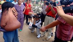 Người đàn ông có khuôn mặt khổng lồ to bằng nửa cơ thể