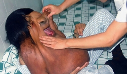 Người đàn ông mang khối u 15kg trên mặt