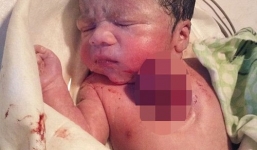 Rớt nước mắt với hình ảnh bé gái có trái tim nằm ngoài lồng ngực