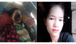 Thiếu nữ xinh đẹp mất nửa mặt vì nhiễm vi khuẩn ăn thịt người