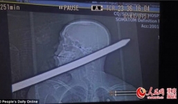 Thoát chết kỳ diệu dù bị thanh thép đâm xuyên đầu