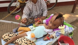 Bé trai 6 tuổi mắc bệnh lạ khiến đầu bị nứt đôi