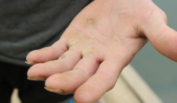 Cách loại bỏ vết chai ở tay cực đơn giản tại nhà