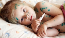 Những lưu ý chăm sóc người bệnh thủy đậu khi vào mùa