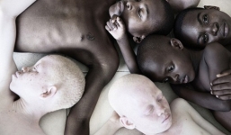 Nỗi đau của trẻ bạch tạng bị thầy phù thủy giết hại làm tà thuật và thần chú tại châu Phi