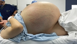 Người phụ nữ bụng to như mang bầu 10 em bé, bác sĩ sốc khi lấy ra thứ kinh khủng này