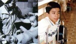 Người Việt đầu tiên bị dính liền cơ thể trở thành giáo sư thỉnh giảng tại Nhật Bản