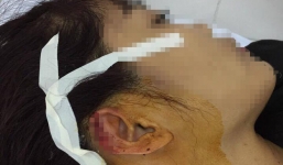 Giáo viên dạy khiêu vũ bất ngờ bị phụ huynh lao vào cắn đứt tai