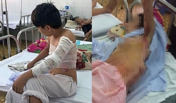 Lao vào cứu mẹ đang bốc cháy, thiếu niên 15 tuổi bị bỏng nặng