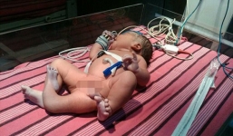 Hy hữu bé sơ sinh chào đời với 3 chân ở Ấn Độ