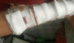 Nữ sinh lớp 10 bị bạn hành hung, lấy dao lam rạch tay