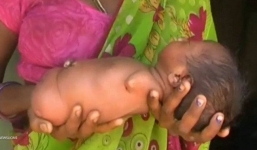 Bé gái sinh ra không có tứ chi, bị dân làng cho là tai họa