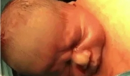 Video: Em bé tự bật ra khỏi bụng mẹ trong ca sinh mổ tự nhiên