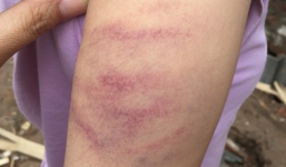 Hà Nội: Học sinh lớp 5 bị cô giáo đánh tím tay