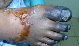 Nam thanh niên tử vong nghi do mắc liên cầu lợn 