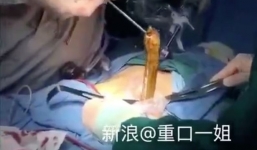 Người đàn ông nuôi lươn trong người để chữa bệnh táo bón