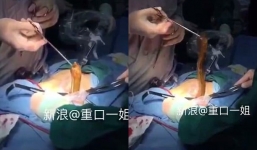 Video: Bác sĩ gắp con lươn dài ngoằng khỏi bụng bệnh nhân